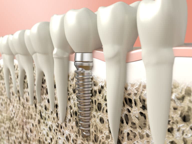 Dental Implants: Bite into Life with Confidence Again