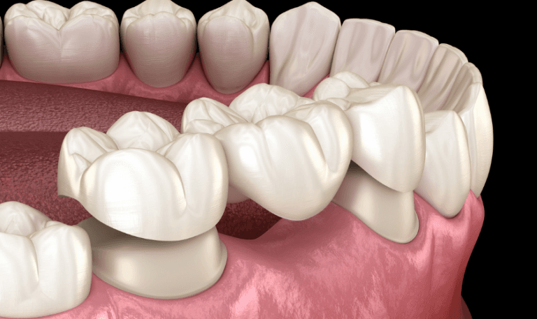 Dental Crown