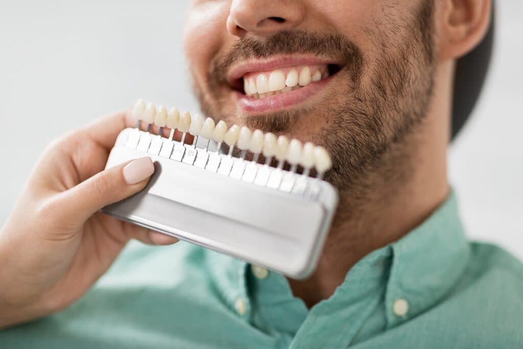 Essential Guide to Veneer Care and Longevity