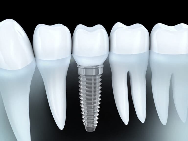 Dental Implants: The Cavity-Proof Teeth Replacement