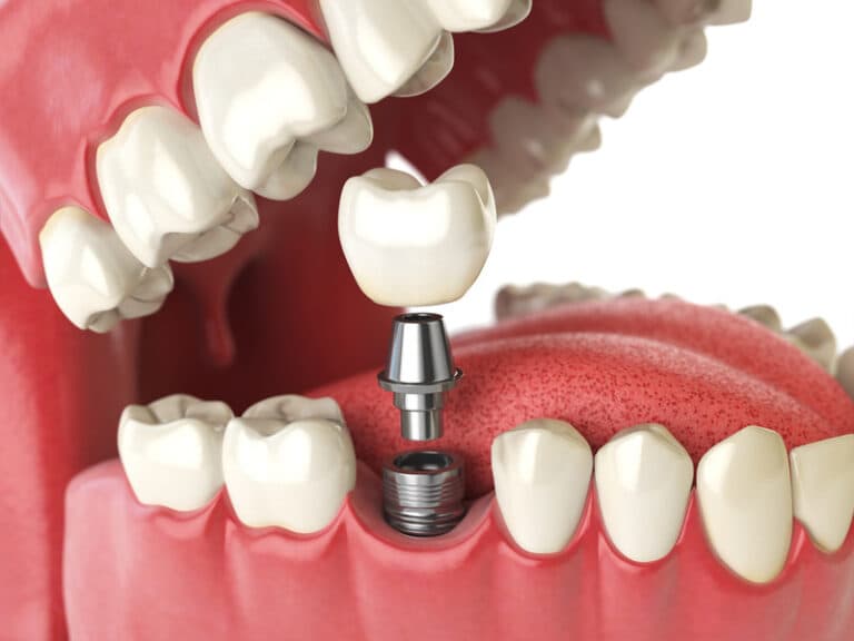 Navigating Dental Implant Options: Your Guide to Smiling