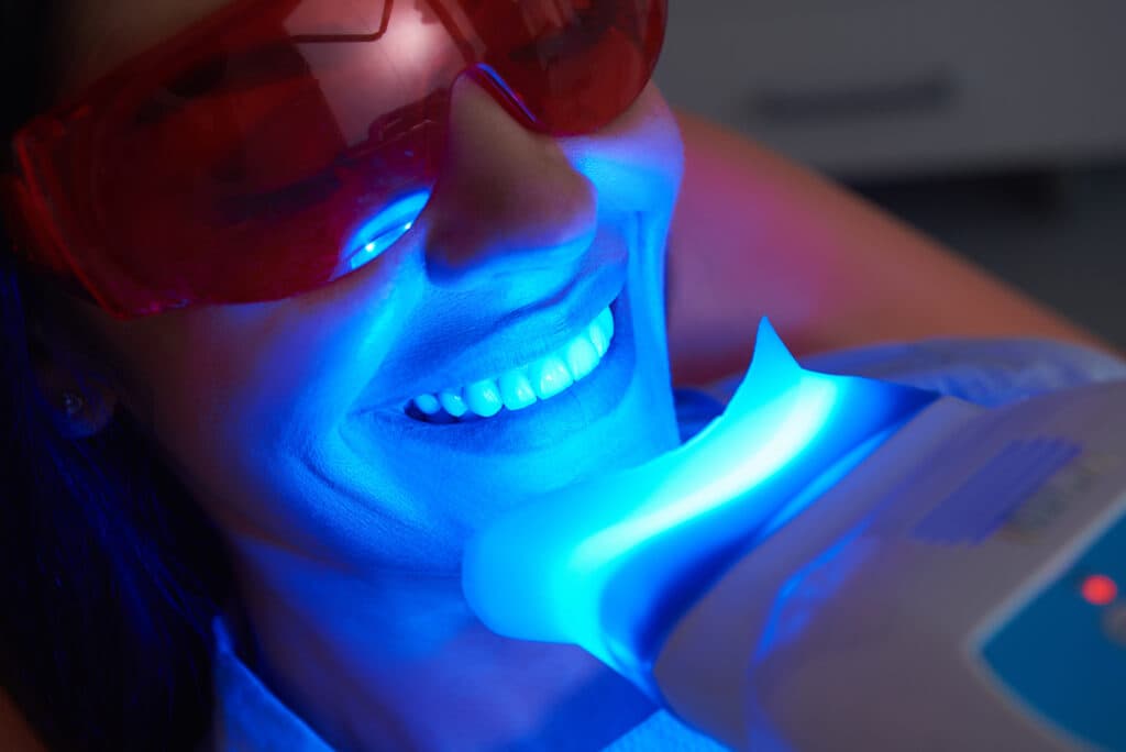 Brighten Your Smile: Professional vs. At-Home Whitening