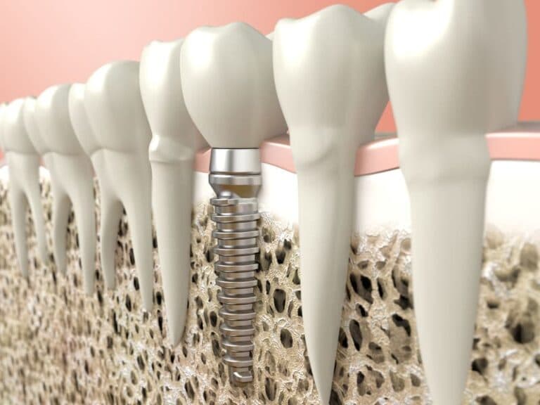 Dental Implants vs Dentures: Choosing Your Ideal Smile