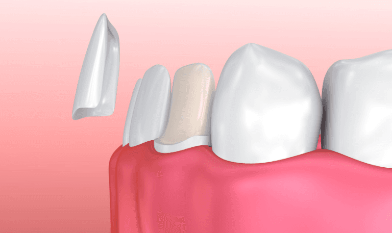 Veneers Can Fix - Stains, Gaps, Crooked Teeth